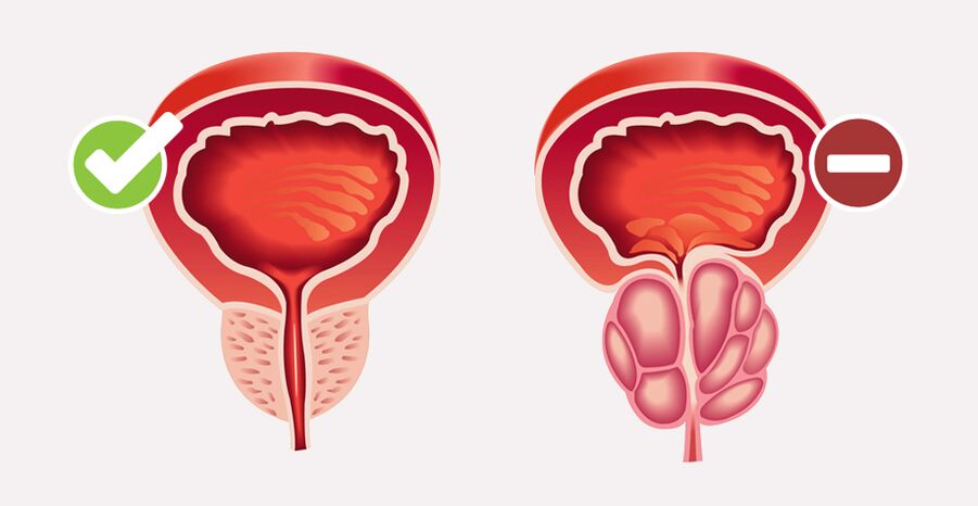 Prostamin Forte нармалізуе памеры і функцыі прастаты